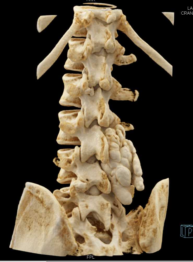 Tumural Calcinosis by the L-Spine with Cinematic Rendering - CTisus CT Scan