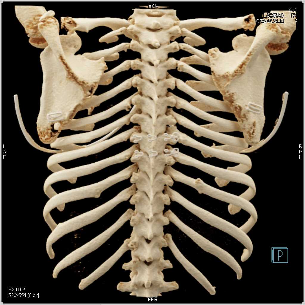 Cinematic Rendering of the Spine and Ribs - CTisus CT Scan