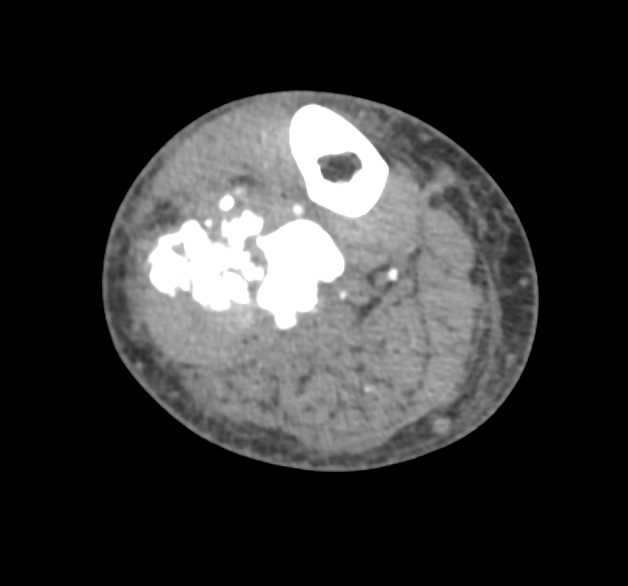 Osteosarcoma of the Fibula - CTisus CT Scan