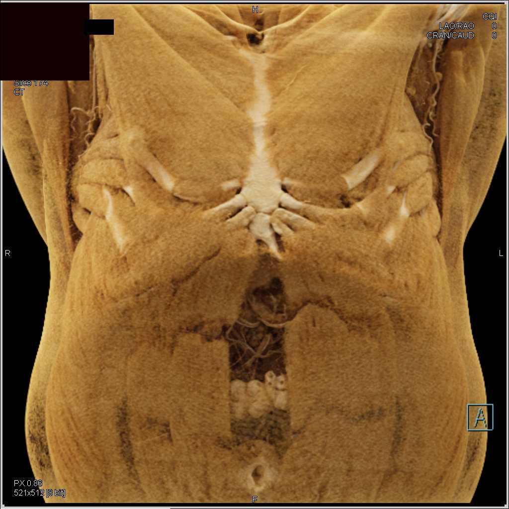 Diastasis of the Rectus Muscle with Cinematic Rendering - CTisus CT Scan