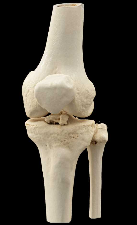 Tibial Plateau Fracture - CTisus CT Scan