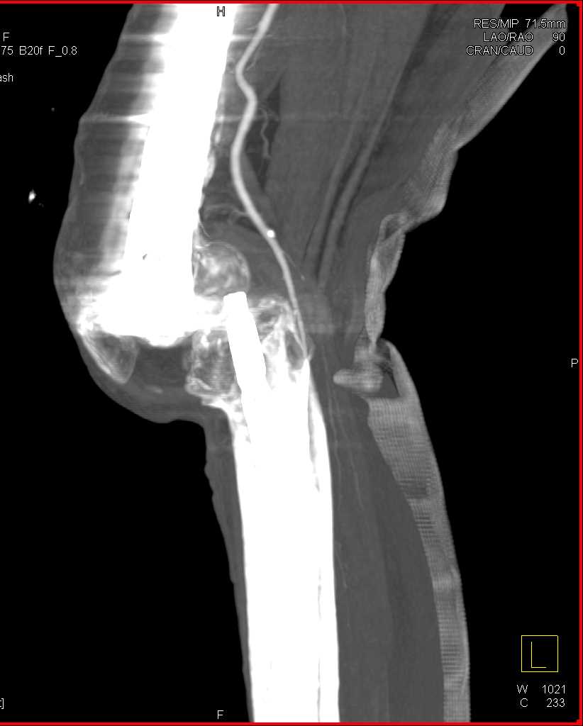 Dislocation Knee Without Vascular Injury - CTisus CT Scan