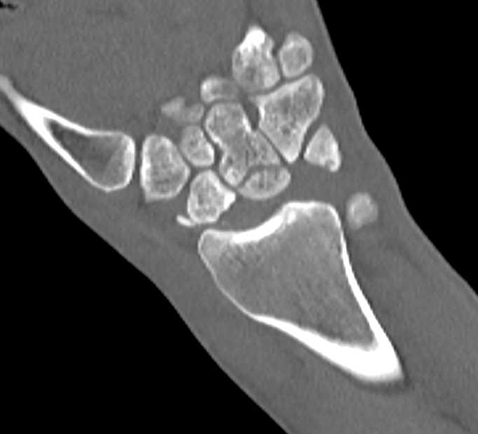 Fracture Dislocation of the Carpal Bones - CTisus CT Scan