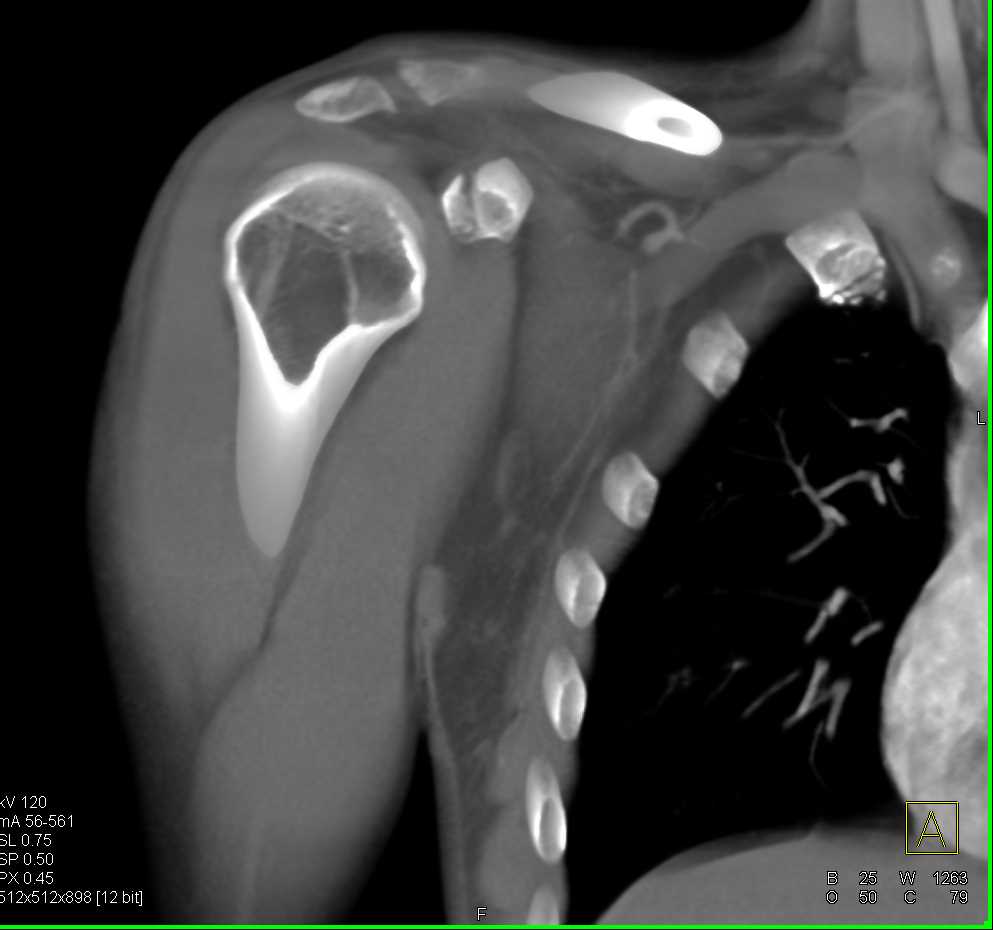 Fracture of Coracoid Process of Scapula - CTisus CT Scan