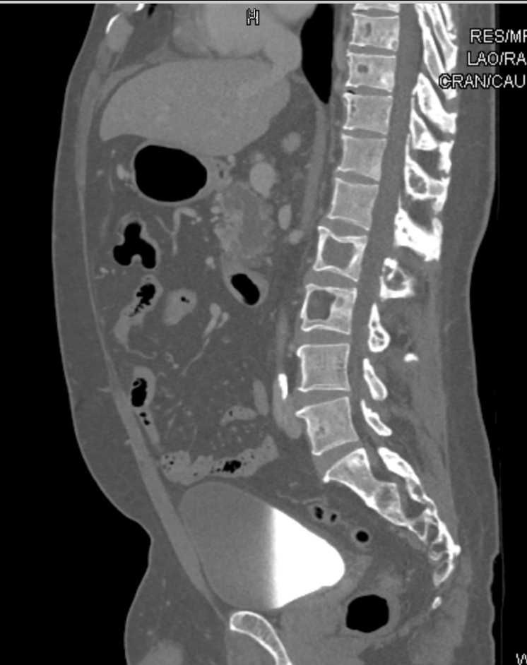 McCune Albright and Bone Changes in Spine - CTisus CT Scan