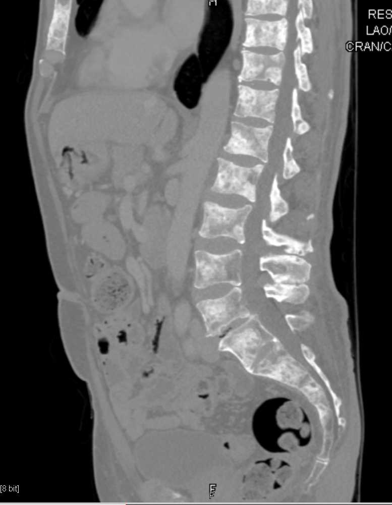 Metastatic Neuroendocrine Tumor to Bone - CTisus CT Scan