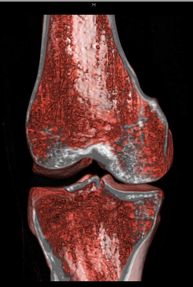 Tibial Plateau Fracture - CTisus CT Scan