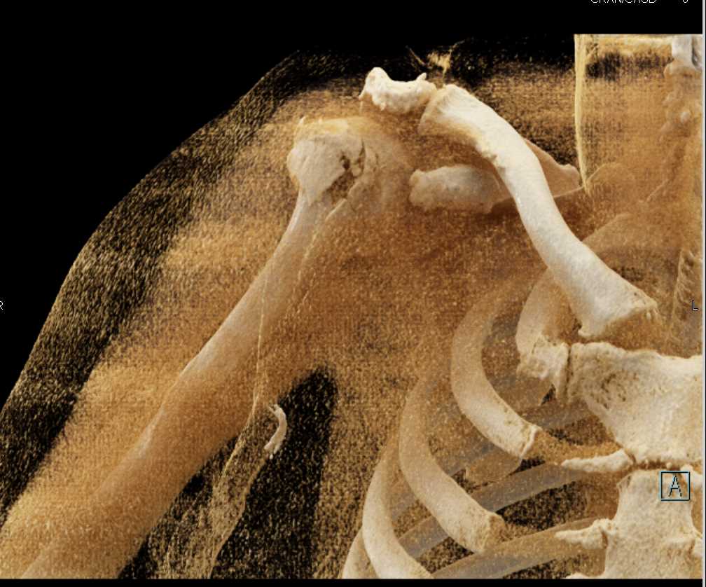 Comminuted Humeral Head Fracture with Cinematic Rendering - CTisus CT Scan