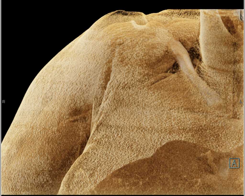 Comminuted Humeral Head Fracture with Cinematic Rendering - CTisus CT Scan