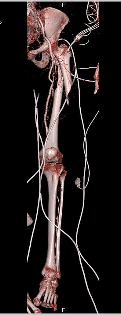 Spiral Femur Fracture Without Vascular Injury - CTisus CT Scan