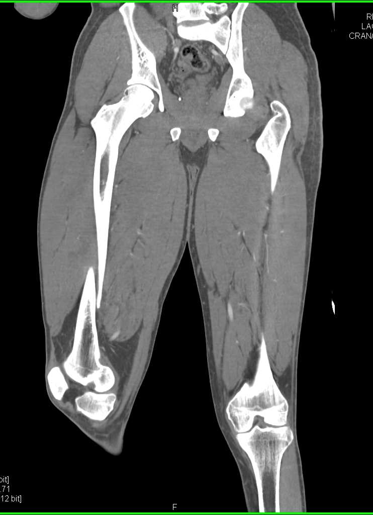 Displaced Femur Fracture Without Vascular Injury - CTisus CT Scan