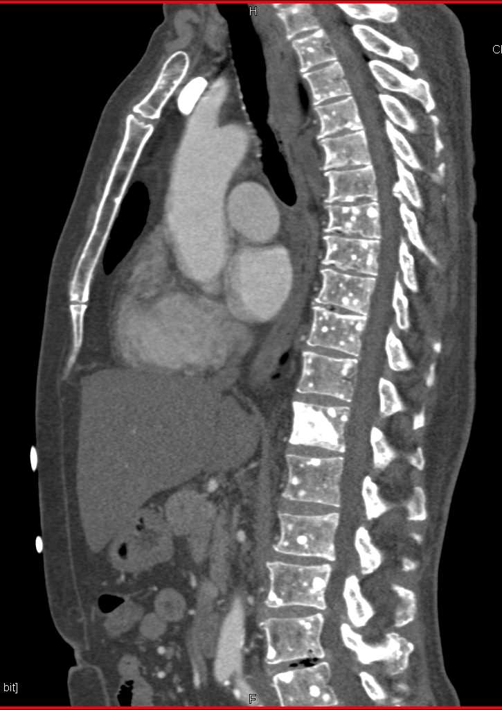 Blastic Bone Metastases from a Neuroendocrine Tumor - CTisus CT Scan