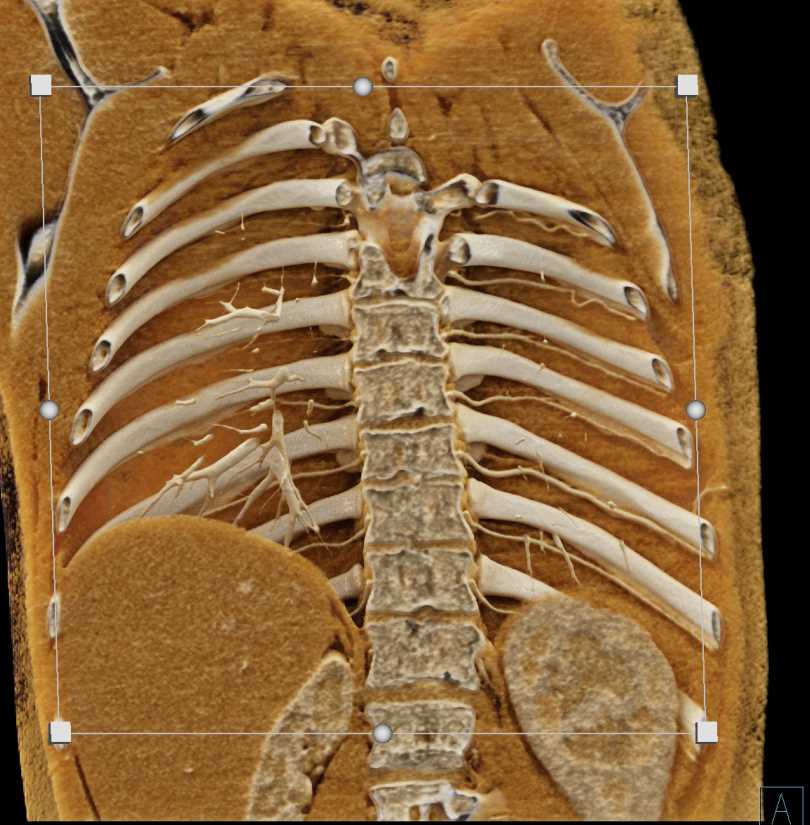 Rib Counting with Cinematic Rendering - CTisus CT Scan