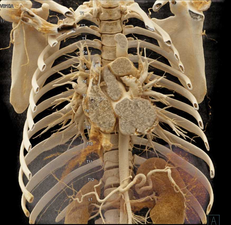 Rib Counting with Cinematic Rendering - Musculoskeletal Case Studies ...