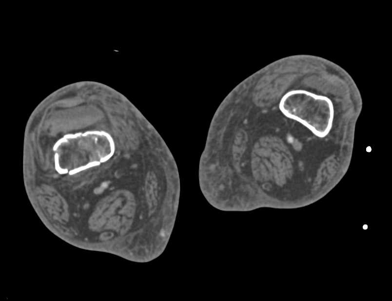 Comminuted Femur Fracture Without Vascular Injury - CTisus CT Scan