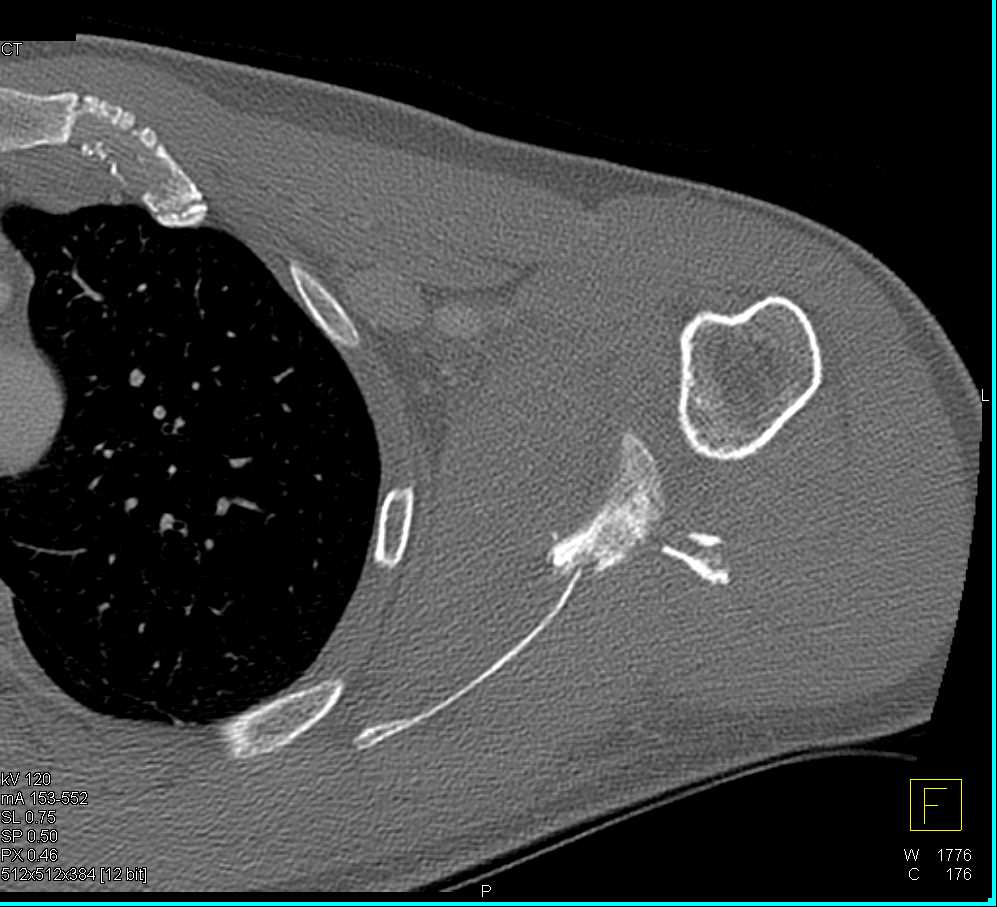 Scapular Fracture - CTisus CT Scan