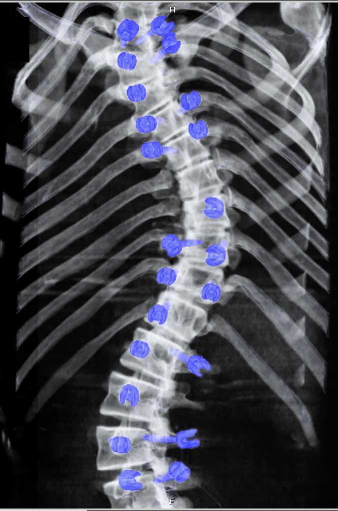 Hardware in the Spine - CTisus CT Scan