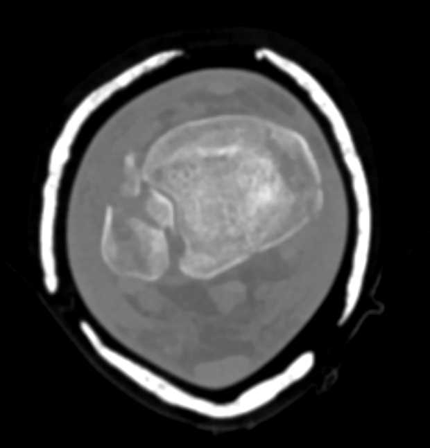 Tibia and Fibular Fracture - CTisus CT Scan