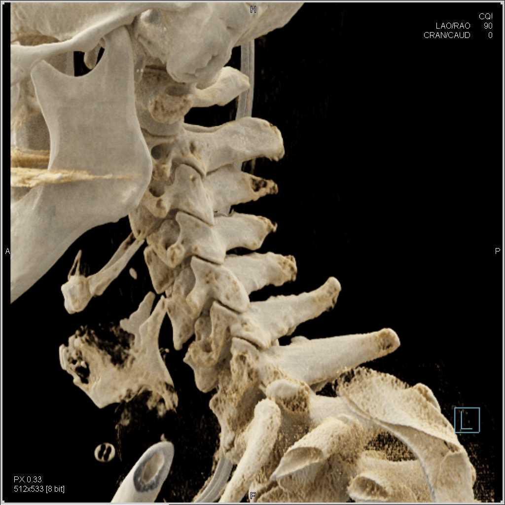 Cinematic Rendering of the C-Spine - CTisus CT Scan