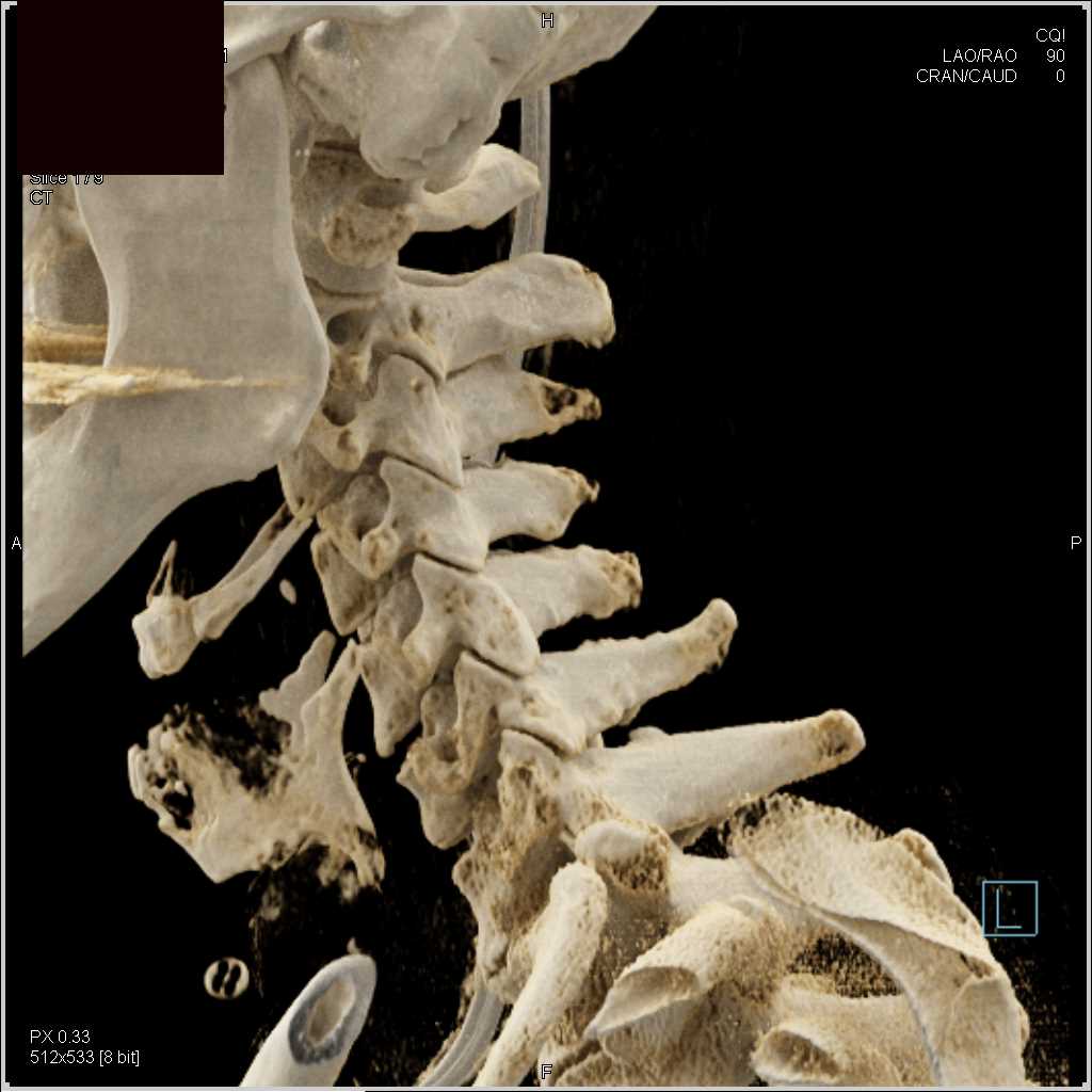 Cinematic Rendering Of The C Spine Musculoskeletal Case Studies