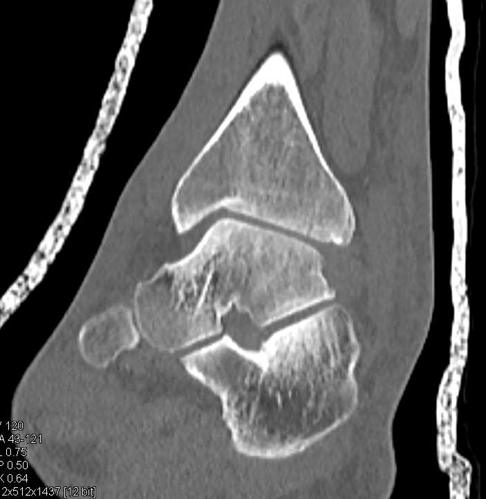 Spiral Tibia and Fibular Fracture - CTisus CT Scan