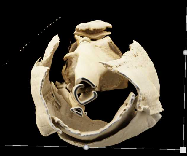 Spiral Tibia and Fibular Fracture with Cinematic Rendering - CTisus CT Scan