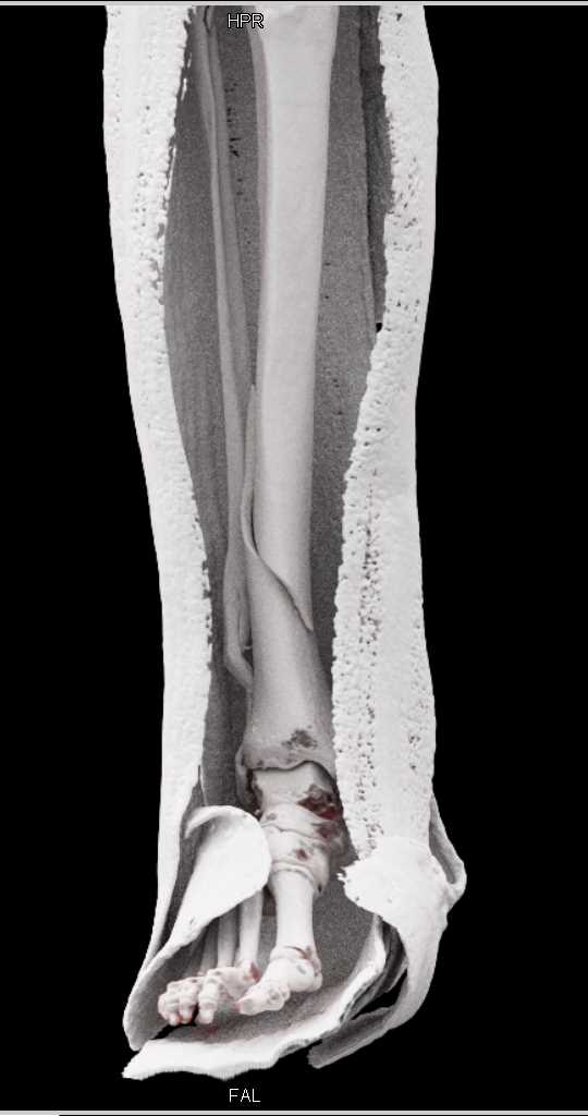 tibial spiral fracture