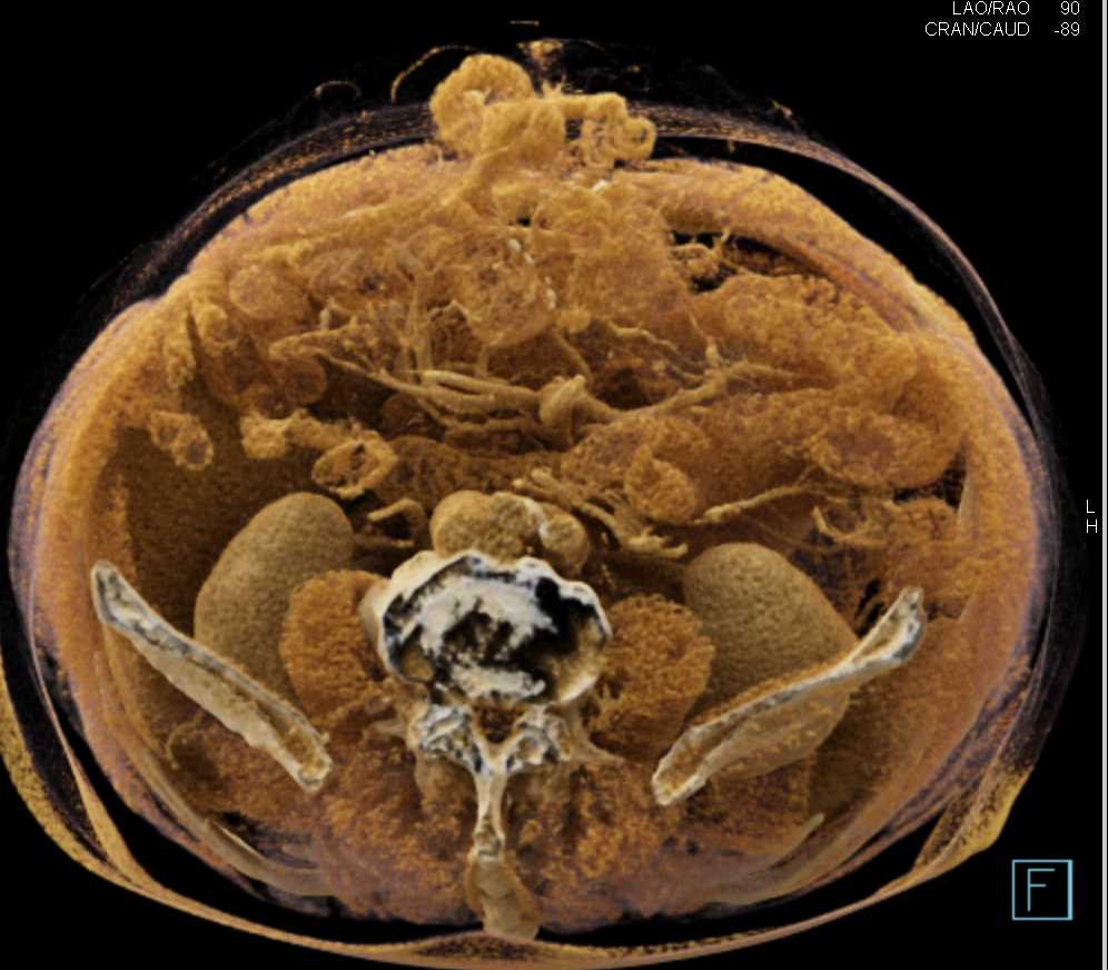 Midline Ventral Hernia - CTisus CT Scan