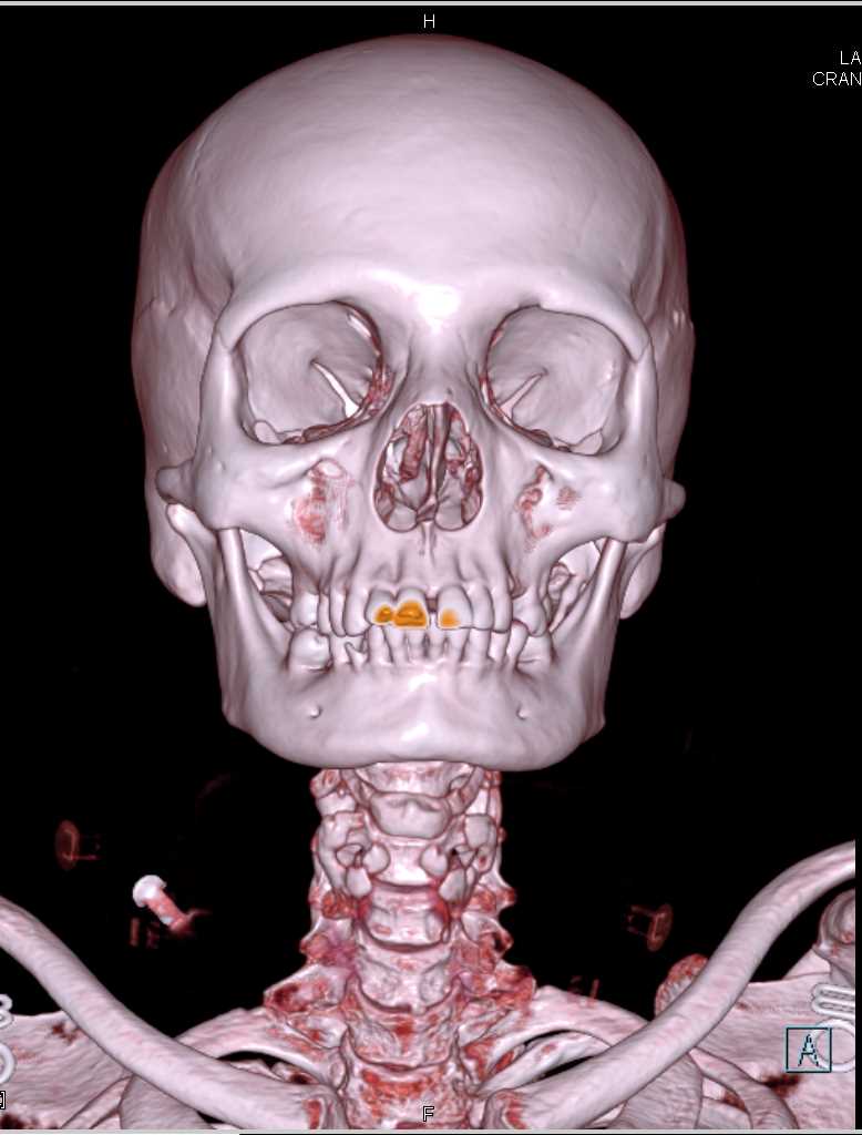 Cinematic Rendering of the Skull and C-Spine - CTisus CT Scan