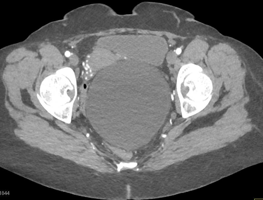 Dural Ectasia Sacrum in Marfans Syndrome - CTisus CT Scan