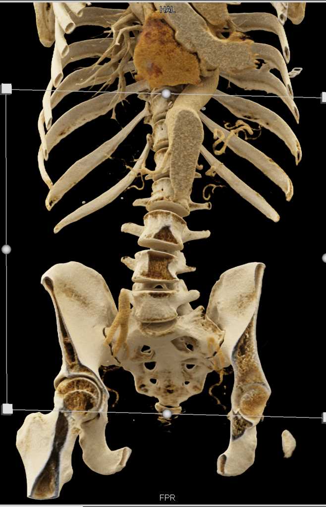 Dural Ectasia Sacrum in Marfans Syndrome - CTisus CT Scan