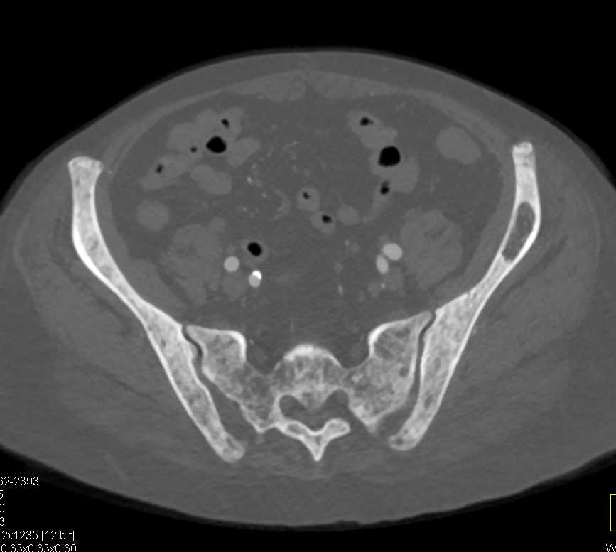 Blastic Metastases from Prostate Cancer - CTisus CT Scan