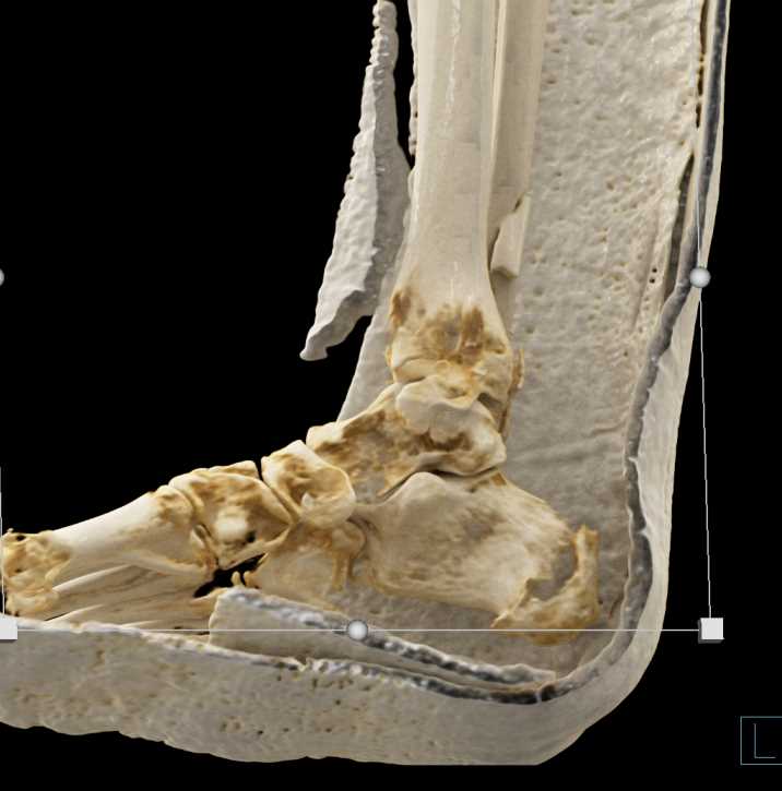 Fracture of the Distal Tibia and Fibula - CTisus CT Scan