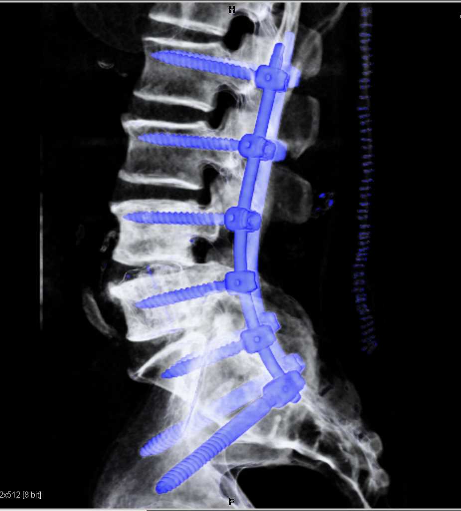 Hardware in the Lumbar Spine Post Repair - CTisus CT Scan