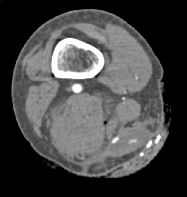 Gunshot Wound (GSW) Knee with Active Contrast Extravasation - CTisus CT Scan