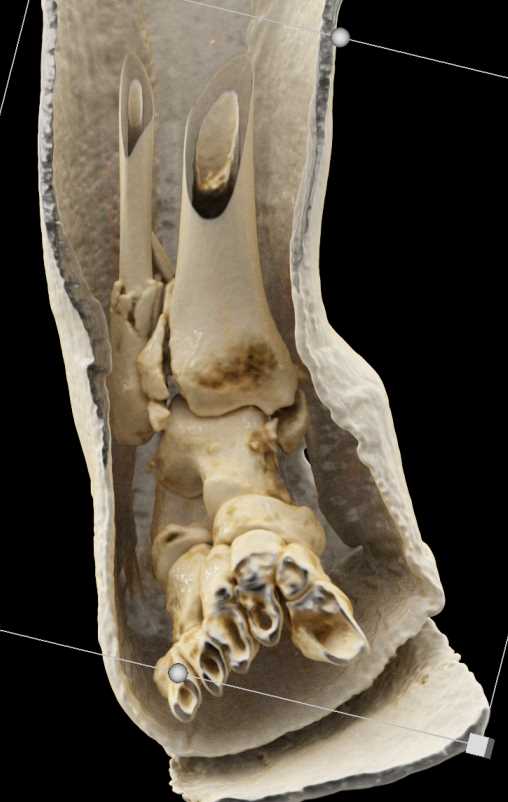 Cinematic Rendering of Tibia and Fibular Fractures - CTisus CT Scan