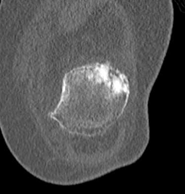 Patellar Fracture - CTisus CT Scan