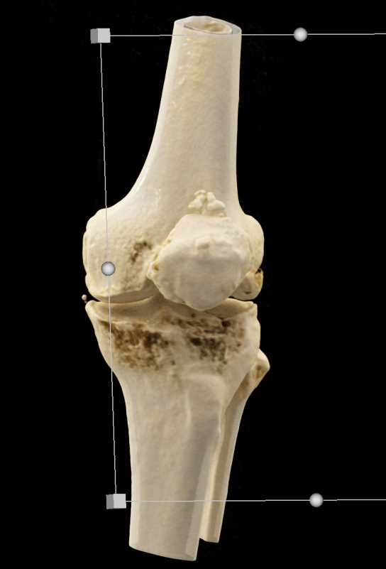 Patellar Fracture - CTisus CT Scan