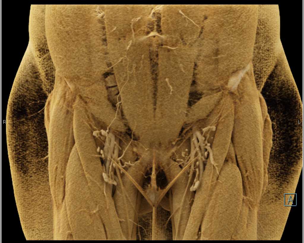 CTA of the Inguinal Region - CTisus CT Scan