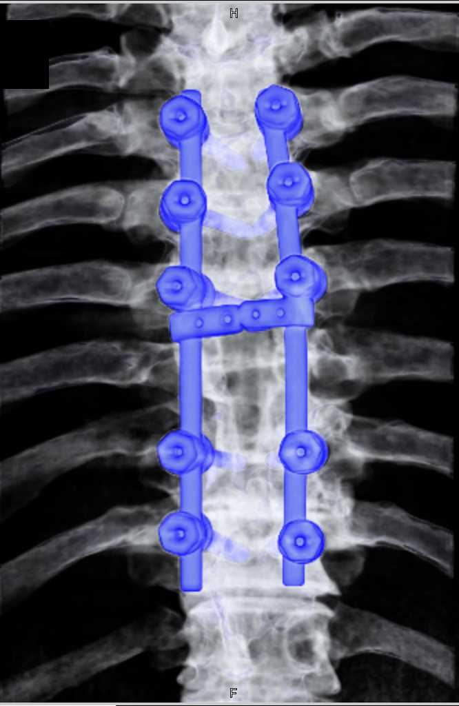 Hardware in Thoracic Spine with Artifact Reduction - CTisus CT Scan