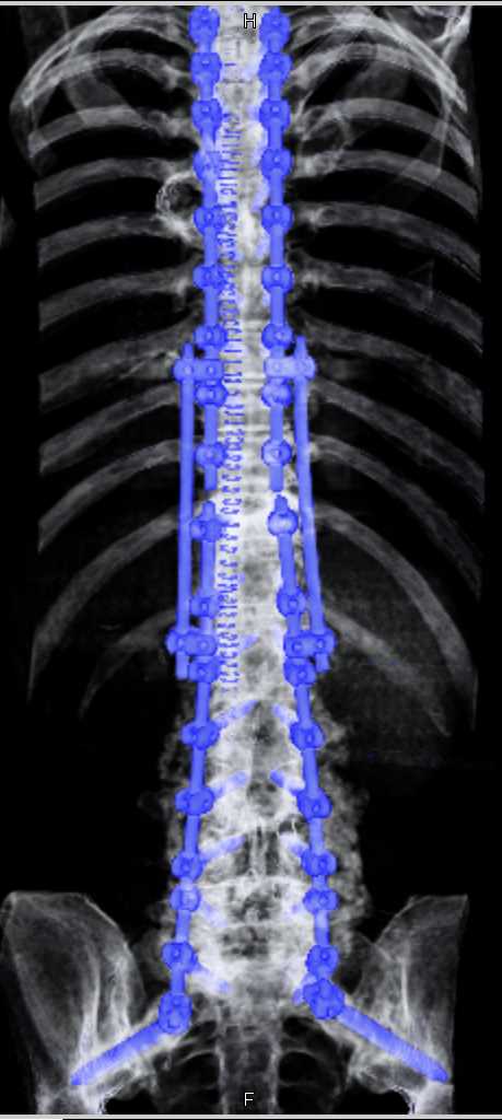 Spinal Repair with Color Coded Hardware - CTisus CT Scan