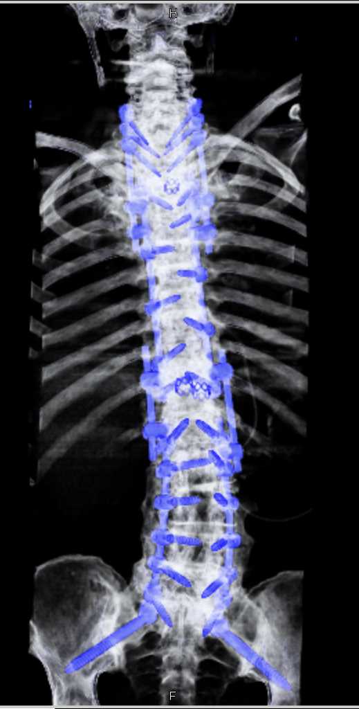 Hardware in Place in the Spine - CTisus CT Scan
