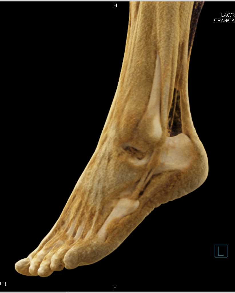 Cinematic Rendering of the Ankle and Its Tendons - CTisus CT Scan