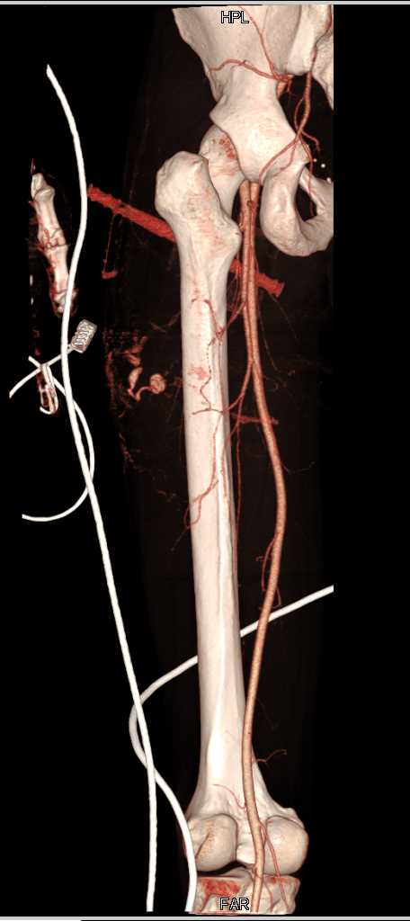 Stab Wound Thigh with Active Bleed and Muscle Injury - CTisus CT Scan