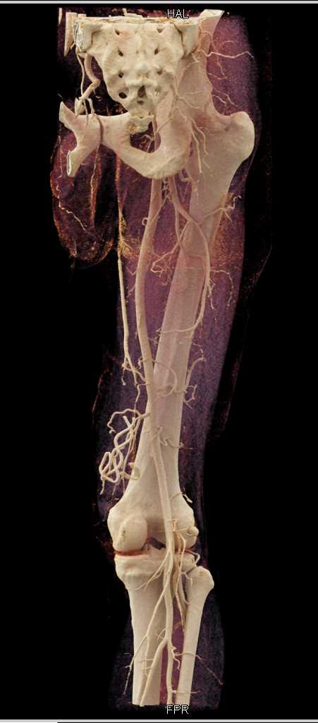 Stab Wound Thigh with Active Bleed and Muscle Injury - CTisus CT Scan