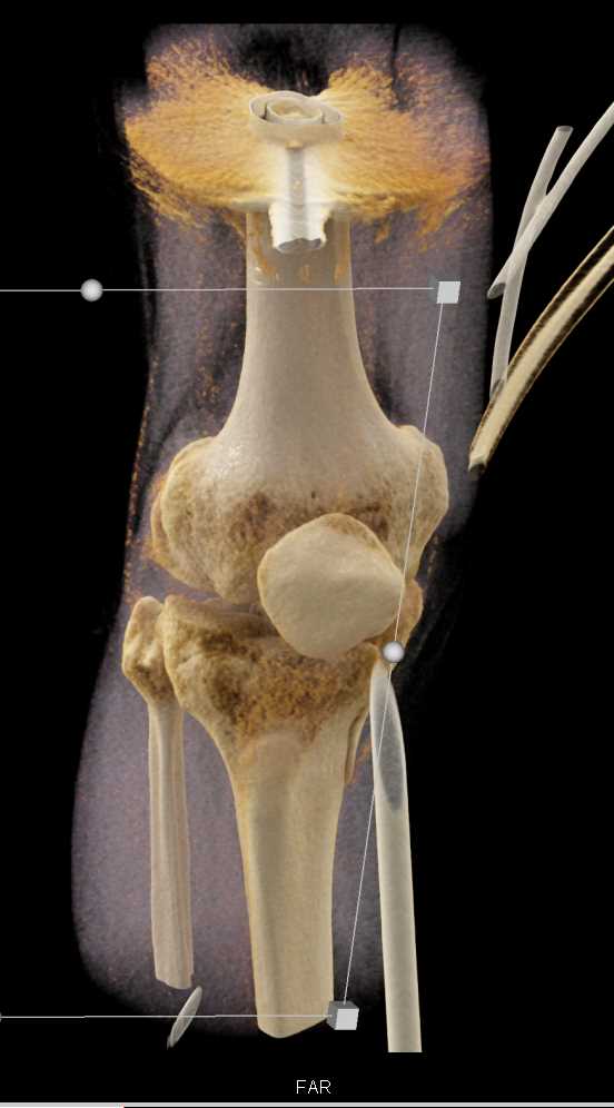 Tibial Plateau Fracture - CTisus CT Scan