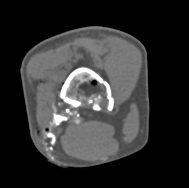 Gunshot Wound (GSW) Femur with Comminuted Fracture - CTisus CT Scan