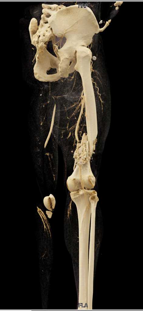 Gunshot Wound (GSW) Femur with Comminuted Fracture - CTisus CT Scan