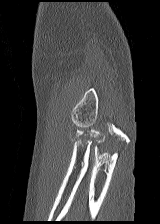 Radius and Ulnar Fractures - CTisus CT Scan