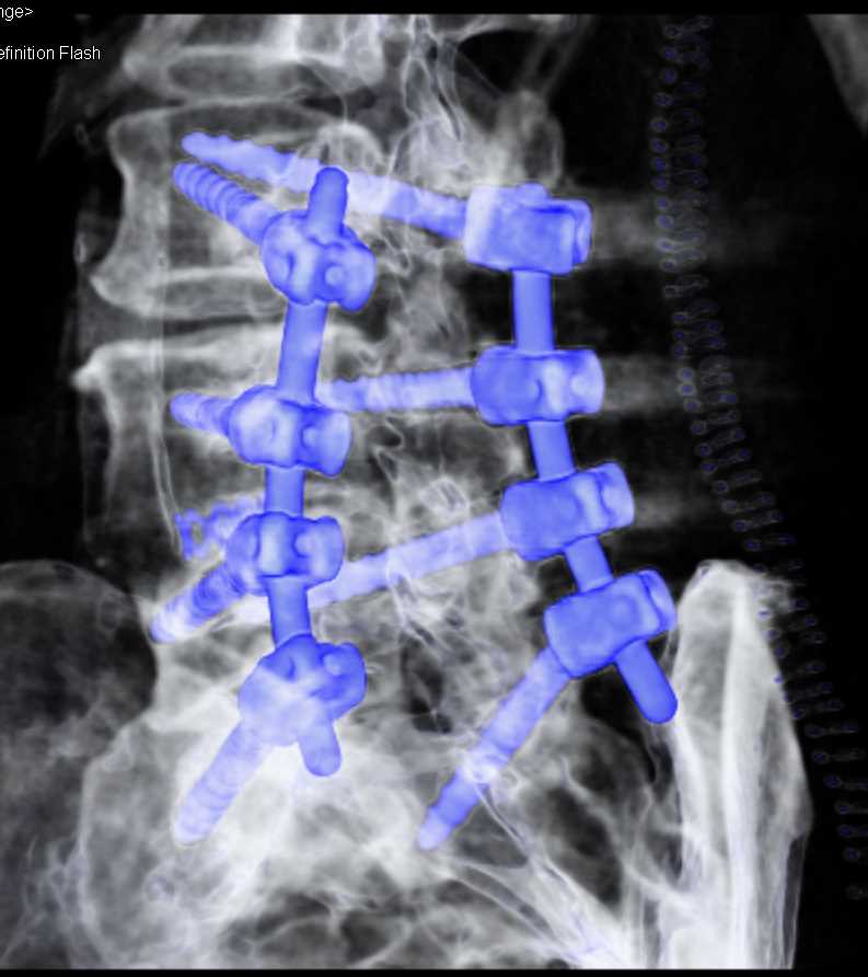 Surgical Hardware in the Spine - CTisus CT Scan